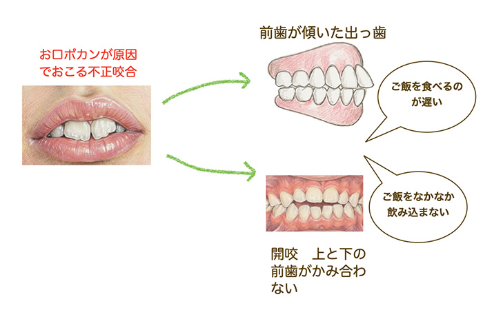 お口ポカンからの不正咬合